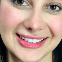 کامپوزیت زیبایی دندان|خدمات آرایشگری و زیبایی|رشت, دباغیان|دیوار