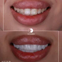 کامپوزیت/لمینت/دندانپزشکی|خدمات آرایشگری و زیبایی|مشهد, کوثر|دیوار