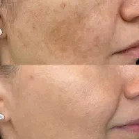 کلینیک تخصصی پوست ومو «پی آر پی،اگزوزوم،مزوتراپی»