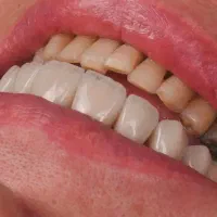 تخفیف ویژه زیبایی کامپوزیت ونییر و‌لمینت ‌