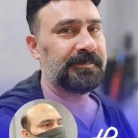 جایگزین مناسب کاشت مو (ترمیم مو)|آرایشی، بهداشتی، درمانی|اصفهان, دستگرده|دیوار