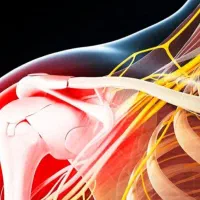 درمان افرادسکته ای .سیاتیک بیحسی دست