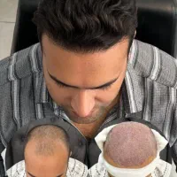 کاشت مو طبیعی/کلینیک فوق تخصصی/ضمانت مادام‌العمر