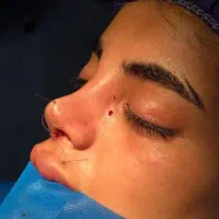 عمل زیبایی بینی،  لیپو،  ابدو، ماموپلاستی، پلک