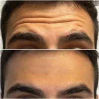 جشنواره ۵۰درصد تخفیف بوتاکس مخصوص خانم ها و آقایان