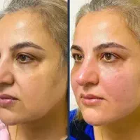 تزریق چربی چساکشن
