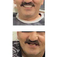 دندانپزشکی و درمان پروتز متحرک و اوردنچر اقساطی