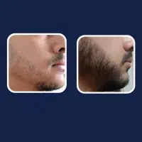ریش ۲|آرایشی، بهداشتی، درمانی|برازجان, |دیوار