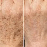 پلاسما . فشیال پاییزه 25%|خدمات زیبایی و سلامت|اصفهان, مهرآباد|دیوار