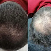 اسکالپ میکرو اسکالپ سر مکمل کاشت مو تضمینی