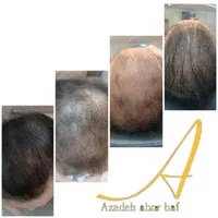 آموزش خدمات میکرواسکالپ کاشت اسکالپ مو تضمینی|خدمات آرایشگری و زیبایی|مشهد, جانباز|دیوار