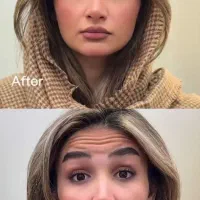 تزریق ژل وبوتاکس ۷۹۰. مید فیس ۴۵۰۰توسط پزشک مجرب