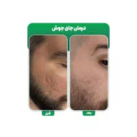 جشنواره پی آر پی prp در مطب پزشک|خدمات آرایشگری و زیبایی|اصفهان, برازنده|دیوار