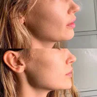 تزریق ژل و بوتاکس|خدمات آرایشگری و زیبایی|کرج, گلشهر|دیوار