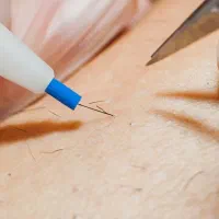 برداشت خال و الکترولیز موهای زائد