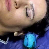 جراحی تخصصی بلفاروپلاستی با تکنیک جدید