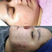 بهترین فیشیال کار در اقبال و وکیل ابادپاکسازی پوست|خدمات آرایشگری و زیبایی|مشهد, اقبال|دیوار