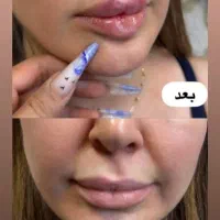 آف یلدایی ژل و بوتاکس|خدمات آرایشگری و زیبایی|دورود, |دیوار