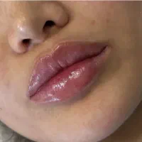 جشنواره یلدایی تخفیف ژل لب،بوتاکس توسط پزشک متخصص|خدمات آرایشگری و زیبایی|کرج, گلشهر|دیوار