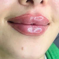 مادلینگ صورت( ژل و بوتاکس)|خدمات آرایشگری و زیبایی|زرقان, |دیوار