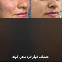 ژل/بوتاکس /فیلر بادی /|خدمات آرایشگری و زیبایی|شیراز, ستارخان|دیوار