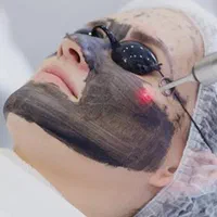 ریمو تتو.پیلینگ کربن هالیوودی. حذف کک مک