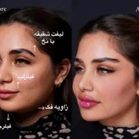 جوانسازی و حجم دهی صورت با کمترین هزینه|خدمات آرایشگری و زیبایی|مشهد, هفت تیر (حافظ)|دیوار