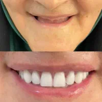 دندان مصنوعی پروتز متحرک