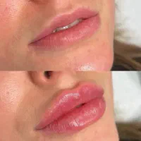 تزریق ژل نورامیس