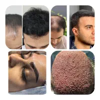 کاشت مواقساطی،به قیمت پارسال مزوکاشت ریش،کاشت‌ابرو