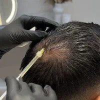 آموزش پی ار پی مزوتراپی لیزر کیوسوییچ خالبرداری|خدمات آموزشی|ملایر, |دیوار