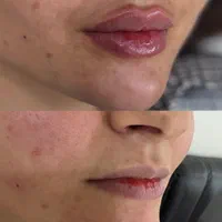 مطب زنان لابیاپلاستی غبغب بوکالفت تزریق چربی|خدمات آرایشگری و زیبایی|تهران, عبدل‌آباد|دیوار