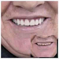 ساخت دندان مصنوعی بیرانوند