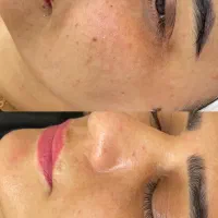 فیشیال تخصصی و درمانی پوست|خدمات آرایشگری و زیبایی|آمل, |دیوار