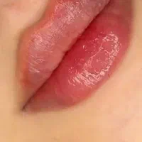 ژل،بوتاکس،مزوتراپی،خالبرداری،پیرسینگ