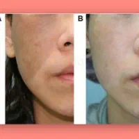 تخفیف واقعی آموزش ژل بوتاکس پی ار پی جوانسازی