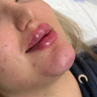 آف تزریق ژل وبوتاکس ومزومووصورت|خدمات آرایشگری و زیبایی|اهواز, نادری|دیوار
