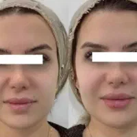 تزریق فیلر و بوتاکس و ترمیم با کمترین هزینه
