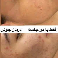 حذف تاتو با لیزر کیوسوئیچ و روشن کننده بیکینی صورت|خدمات آرایشگری و زیبایی|ارومیه, |دیوار