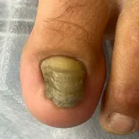 فرورفتگی ناخن توگوشت|آرایشی، بهداشتی، درمانی|انار, |دیوار