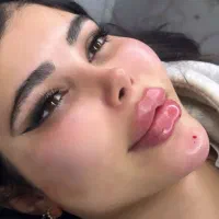 تزریق تخصصی ژل کانتورینگ صورت وزاویه فک وفیشیال|خدمات آرایشگری و زیبایی|کرج, گلشهر|دیوار