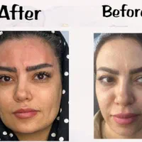 تزریق فیلر بوتاکس و لیفت افتادگی صورت و چشم|خدمات آرایشگری و زیبایی|شیراز, عفیف‌آباد|دیوار