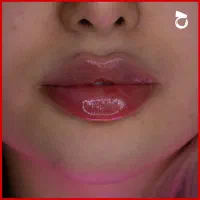 تخفیفات ۵۰ درصدی ژل و بوتاکس و فیلر دکتر زیبایی