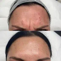 اموزش. بوتاکس فول فیس چشم گربه ای لیفت شقیقه|خدمات آرایشگری و زیبایی|خرم‌آباد, |دیوار