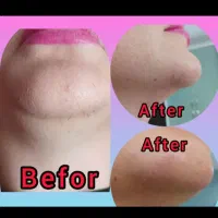 الکترولیز روشی قطعی حذف موهای زائد صورت|خدمات آرایشگری و زیبایی|اشنویه, |دیوار