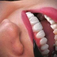 ایمپیلنت اوردنچر درمانی