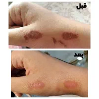 درمان بیماری هاباطب سنتی واصلاح مزاج|خدمات آرایشگری و زیبایی|بروجن, |دیوار