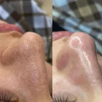 پاکسازی و فیشیال صورت و گردن