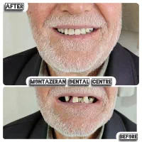 دندانسازی دندان مصنوعی یک روزه ضمانتی