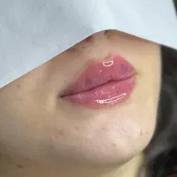 قیمتهای استثنایی کلینیک زیبایی تزریق فیلر ،بوتاکس|خدمات آرایشگری و زیبایی|نسیمشهر, |دیوار